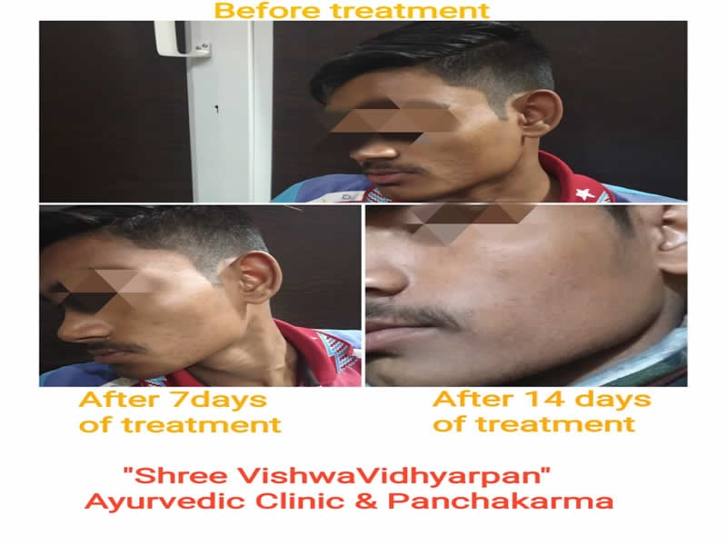Shree VishwaVidhyarpan Clinic Before-After Treatment
